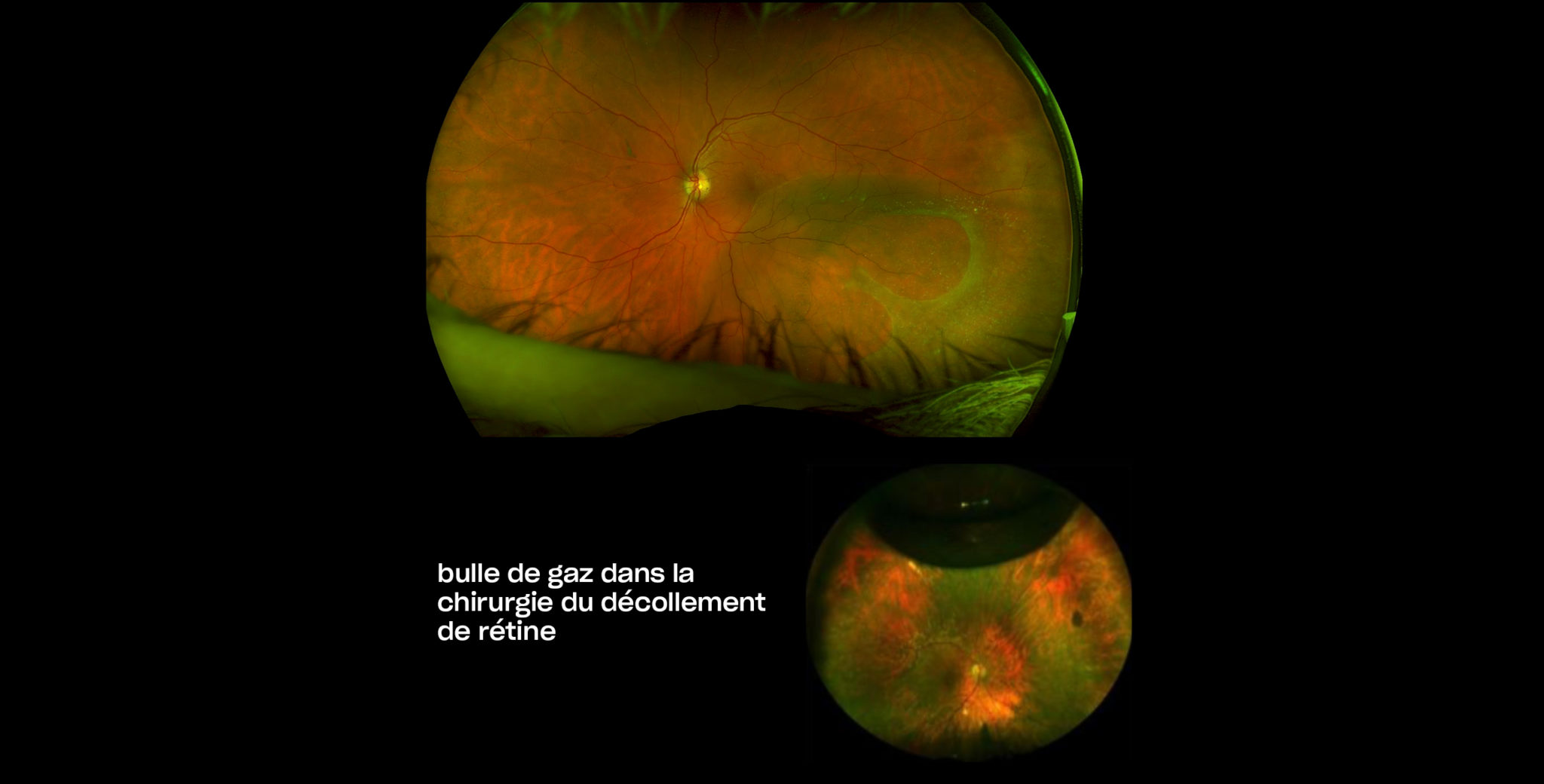 Décollement de rétine à Plaisir | Décollement de la rétine chirurgie | Centre ophtalmologique | COPYV