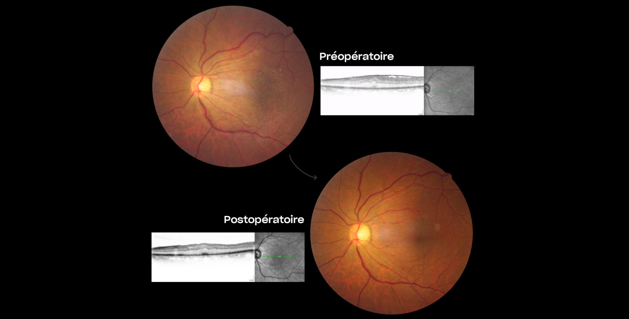 Chirurgie de la membrane épirétinienne à Plaisir | Coût opération membrane épirétinienne | Ophtalmologie | COPYV